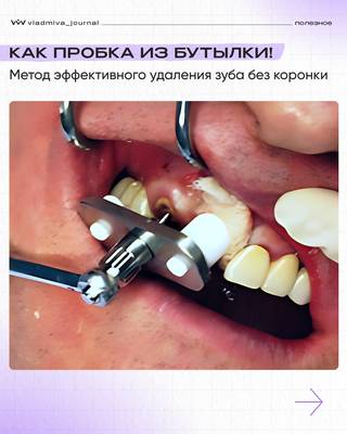 Удаление зуба без коронки — метод Лазутикова.